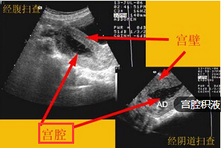 宫腔积液