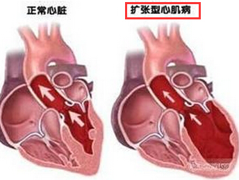 心肌炎