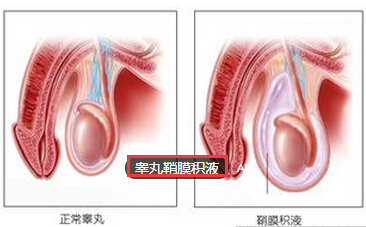 小儿睾丸鞘膜积液