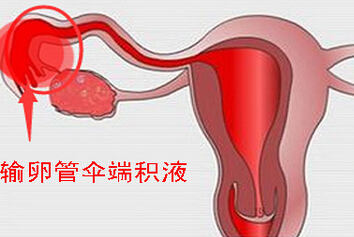 输卵管伞端积液