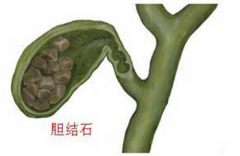 老太不忌口 吃出千颗胆结石
