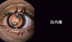 白内障逐渐趋于年轻化 视力突变模糊要留意