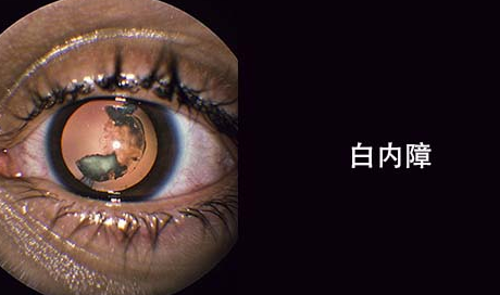 白内障