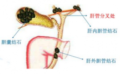 不吃早饭长期吃素 不良习惯诱发胆结石