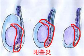 男性附睾炎的病因与治疗