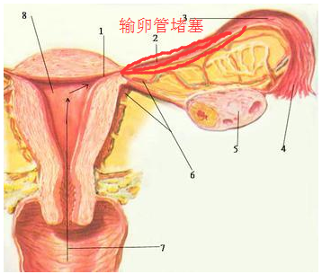 输卵管堵塞的治疗方式