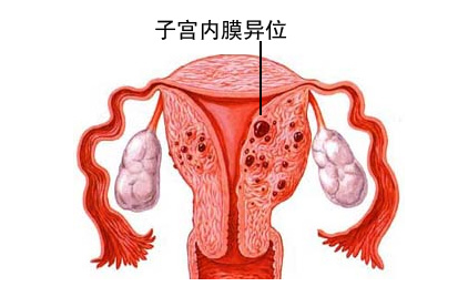 子宫内膜异位症