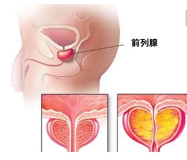 得了前列腺炎怎么办？