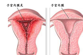 子宫内膜炎的症状