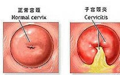 慢性宫颈炎的症状和预防