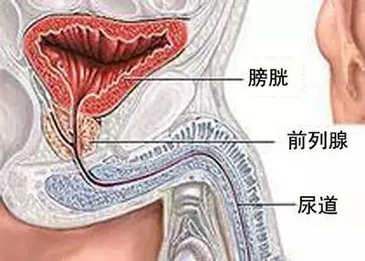 前列腺炎的治疗