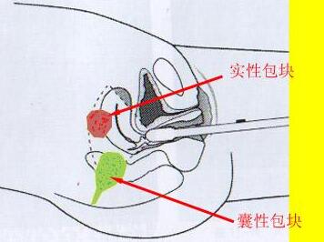 盆腔包块怎么治疗？