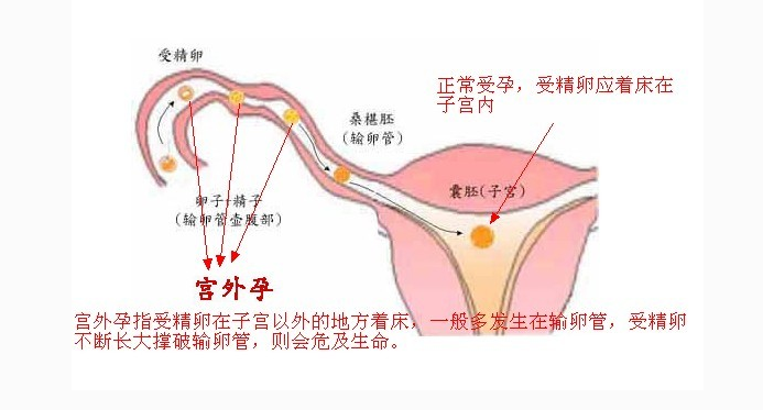 妇炎丸可预防宫外孕?