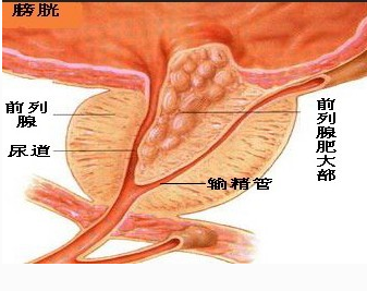 前列腺肥大的治疗