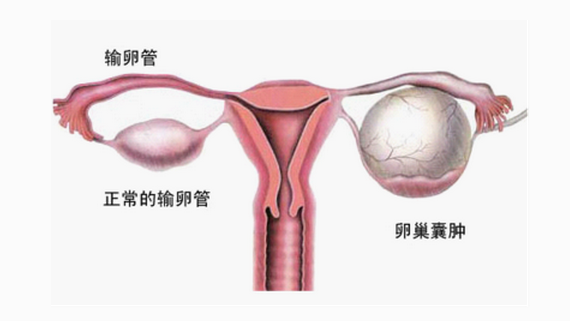 妇炎丸治疗卵巢囊肿