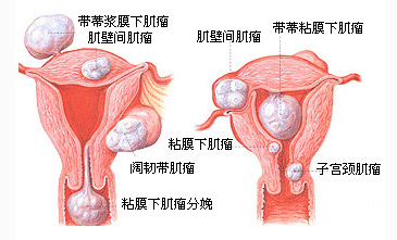 中医治疗卵巢囊肿