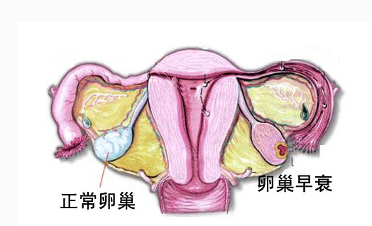 卵巢早衰中医治疗