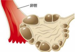 多囊卵巢综合征能自愈吗？ 没有自愈可能