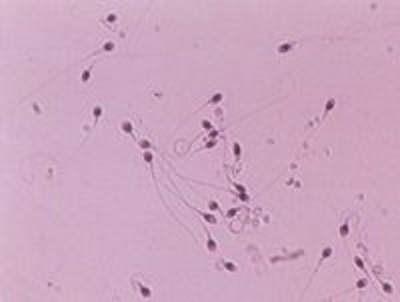 男性精子畸形