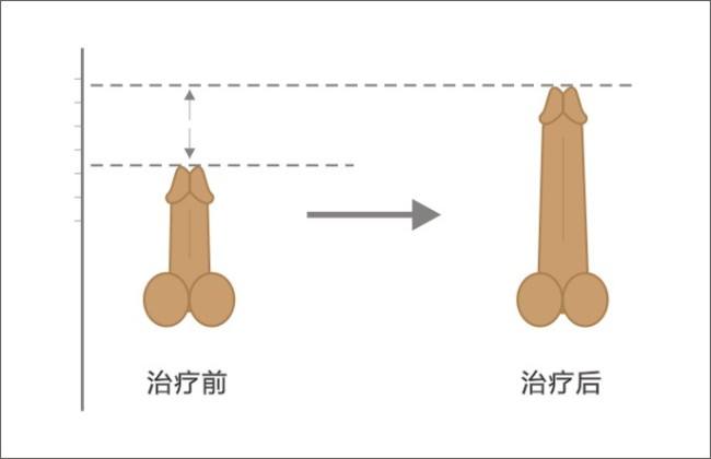 阴茎延长术