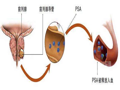 前列腺癌