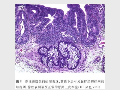 腺性膀胱炎