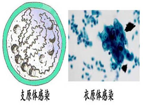 女性支原体感染