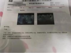 腰腹痛、排卵期出血严重，五个疗程治愈子宫内