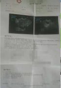左下腹隐痛、月经异常，一个疗程治愈盆腔积液