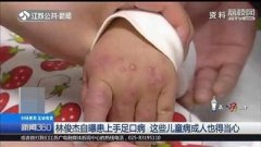 林俊杰得手足口病，你对这种病了解多少?它并非是儿童专属病